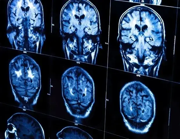 Brain Signal Predicts Child Attention Lapses